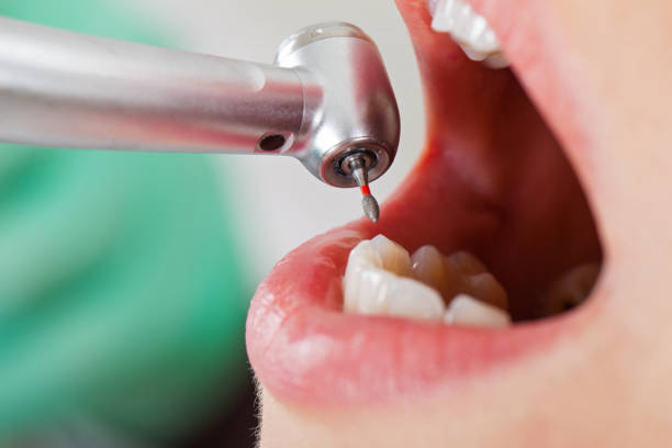 Teeth Whitening in NC